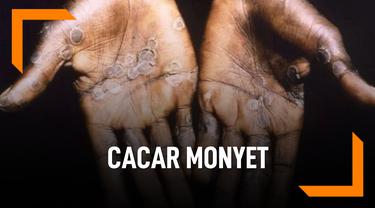Kemenkes Konfirmasi Temuan Pasien Pertama Cacar Monyet Di Jakarta